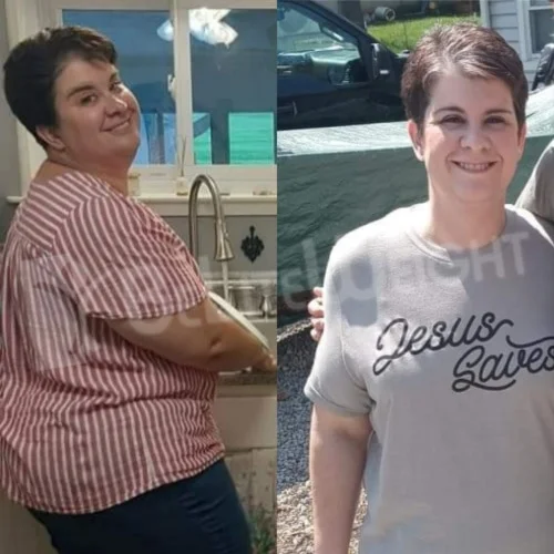 Gastric Sleeve before and after